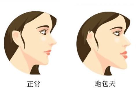 什么是地包天？地包天長(zhǎng)什么樣子？地包天牙齒圖片