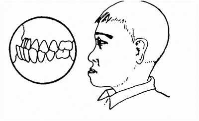 什么是地包天？地包天長(zhǎng)什么樣子？地包天牙齒圖片