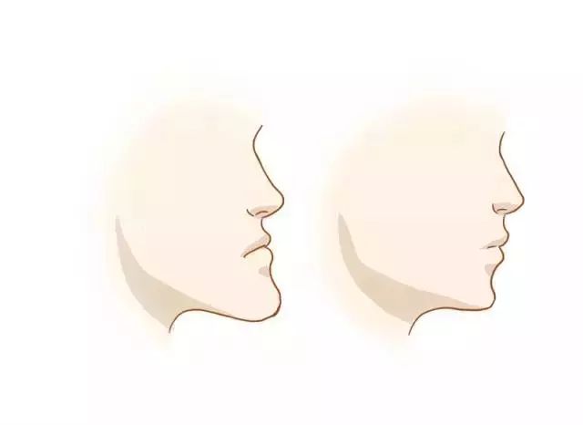 什么是地包天？地包天長(zhǎng)什么樣子？地包天牙齒圖片